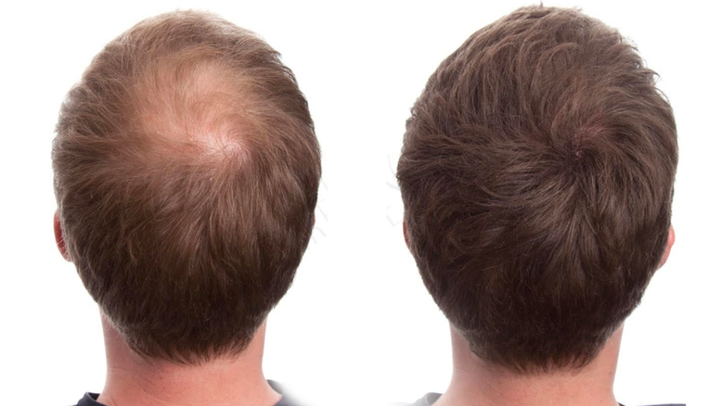 Minoxidil Funciona para cabelo e barba?